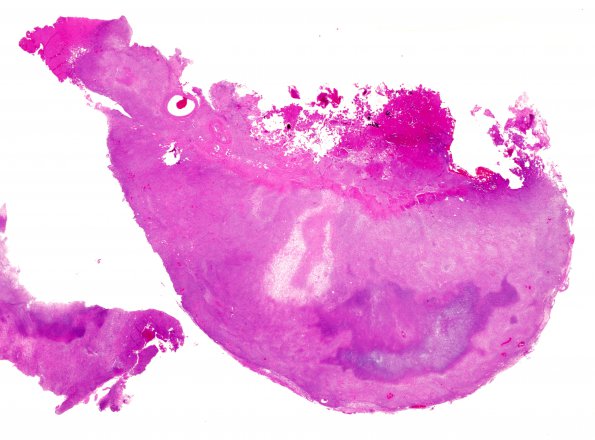 19B1 Meningioma, anaplastic (Case 19) H&E whole mount