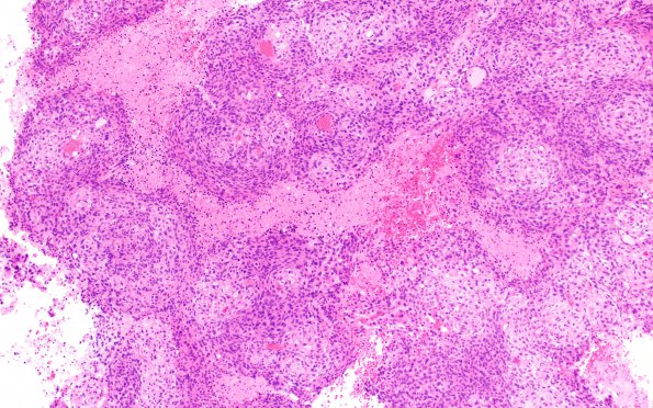 19B2 Meningioma, anaplastic (Case 19) H&E 10X