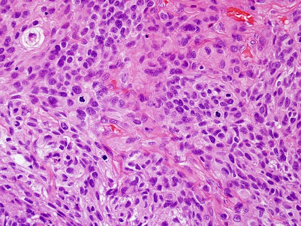 19B3 Meningioma, anaplastic (Case 19) H&E 4.jpg