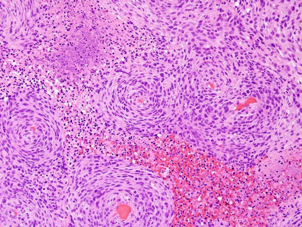 19B4 Meningioma, anaplastic (Case 19) H&E 7.jpg