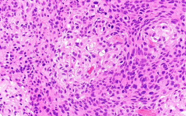 19B5 Meningioma, anaplastic (Case 19) H&E 40X 3