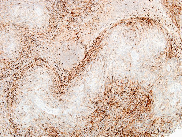 19C1 Meningioma, anaplastic (Case 19 EMA 3.jpg