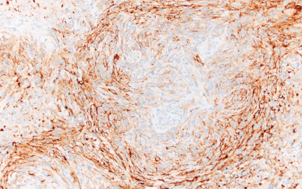 19C2 Meningioma, anaplastic (Case 19) EMA 20X