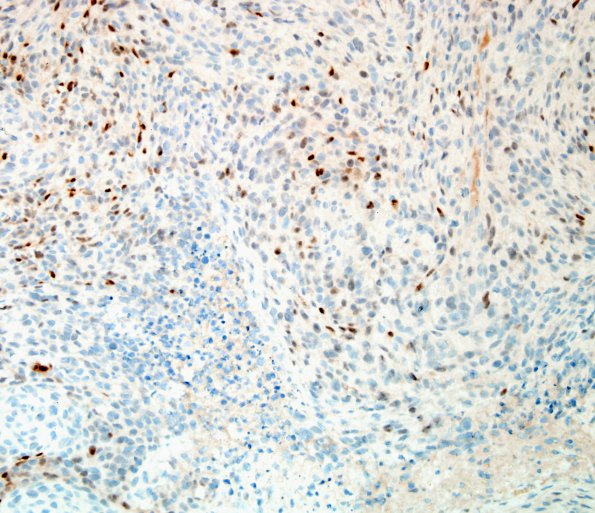 19D Meningioma, anaplastic (Case 19) PR 4.jpg