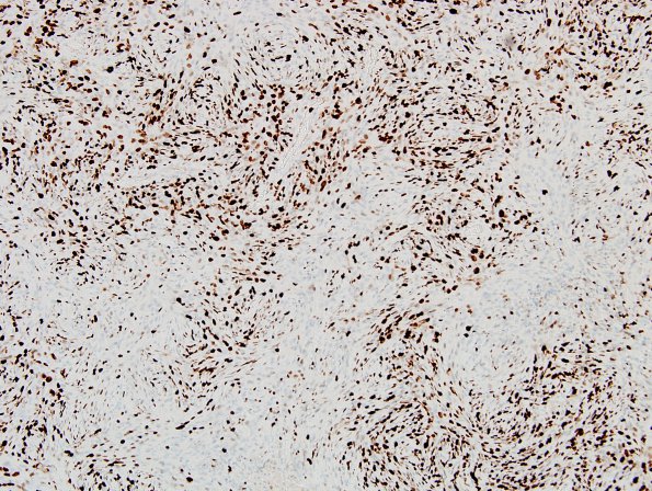 19E Meningioma, anaplastic (Case 19) Ki67 2.jpg