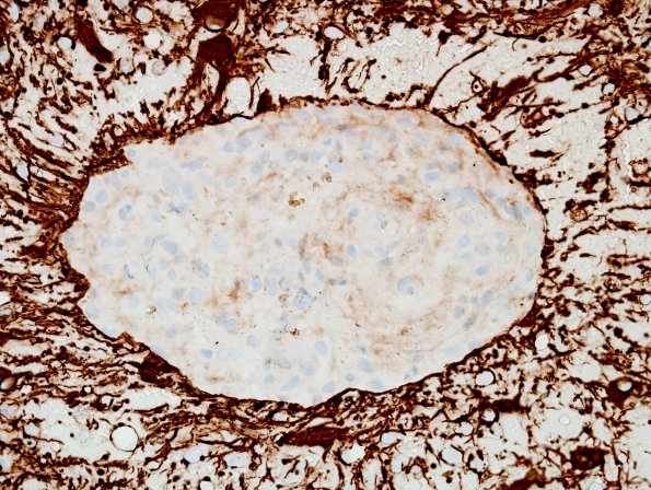 19F Meningioma, anaplastic (Case 19) GFAP 1.jpg