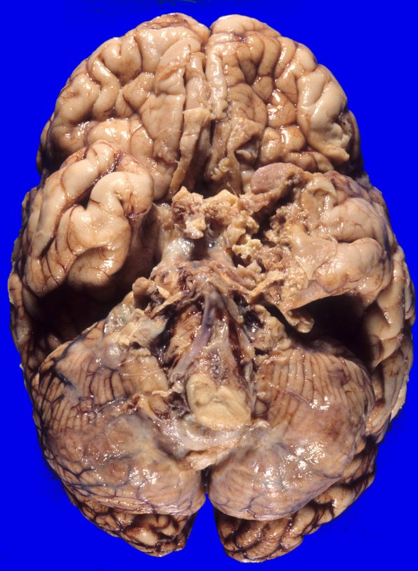 1A1 Meningioma, Anaplastic (Case 1) 7