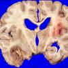 1A2 Meningioma, Anaplastic (Case 1) 6