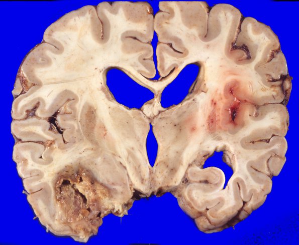 1A2 Meningioma, Anaplastic (Case 1) 6