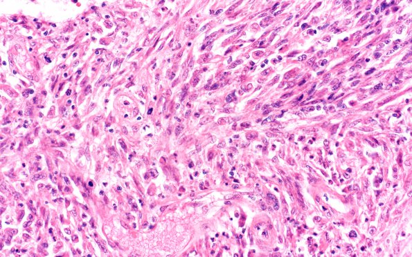 1B2 Meningioma, Anaplastic (Case 1) H&E N3 40X