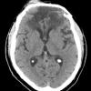 20A1 Meningioma, WHO III & metaplasia (Case 20) H&E 4