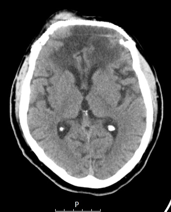 20A1 Meningioma, WHO III & metaplasia (Case 20) H&E 4