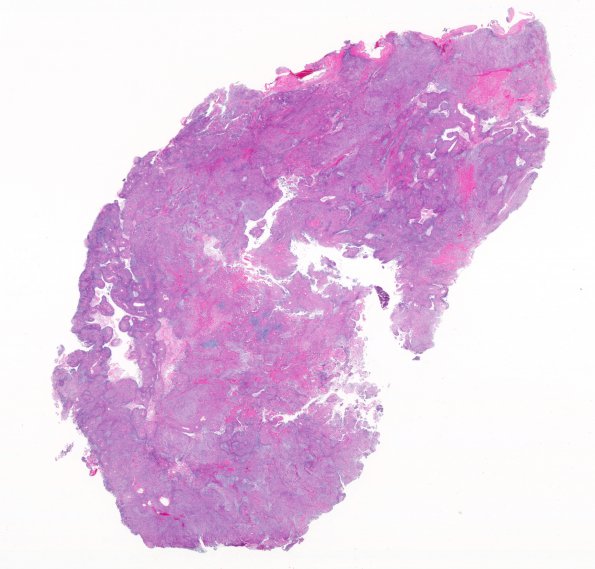 20B1 Meningioma, WHO III & metaplasia (Case 20) H&E 4