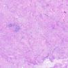 20B2 Meningioma, WHO III & metaplasia (Case 20) H&E 2