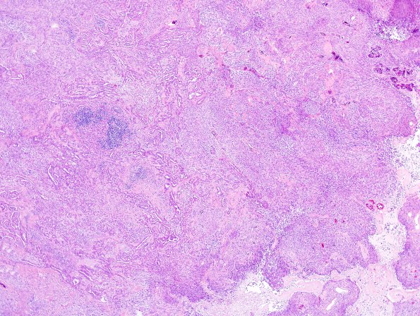 20B2 Meningioma, WHO III & metaplasia (Case 20) H&E 2