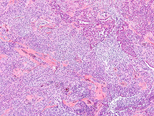 20B3 Meningioma, WHO III & metaplasia (Case 20) H&E 14