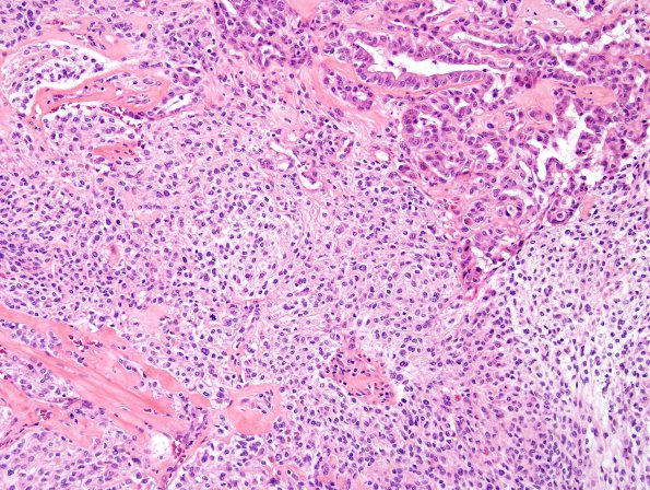 20B4 Meningioma, WHO III & metaplasia (Case 20) H&E 11