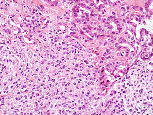 20B5 Meningioma, WHO III & metaplasia (Case 20) H&E 16