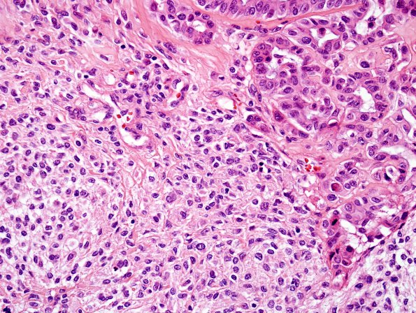 20B6 Meningioma, WHO III & metaplasia (Case 20) H&E 12