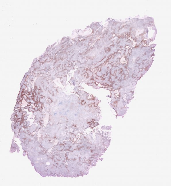 20C1 Meningioma, WHO III & metaplasia (Case 20) EMA WM