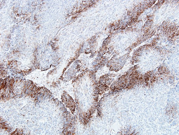 20C2 Meningioma, WHO III & metaplasia (Case 20) EMA 9