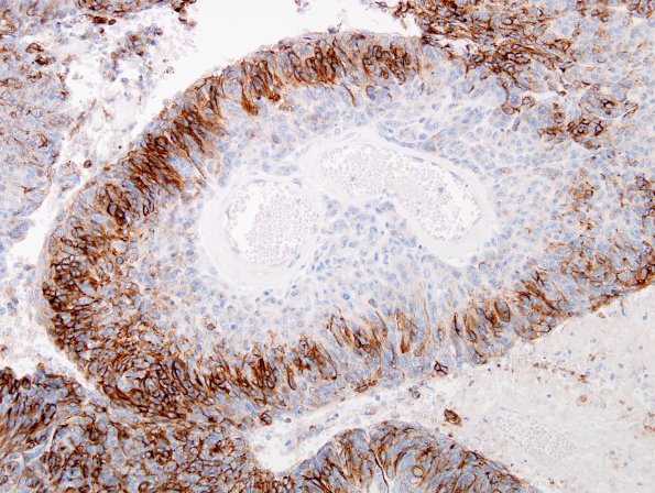 20C3 Meningioma, WHO III & metaplasia (Case 20) EMA 2