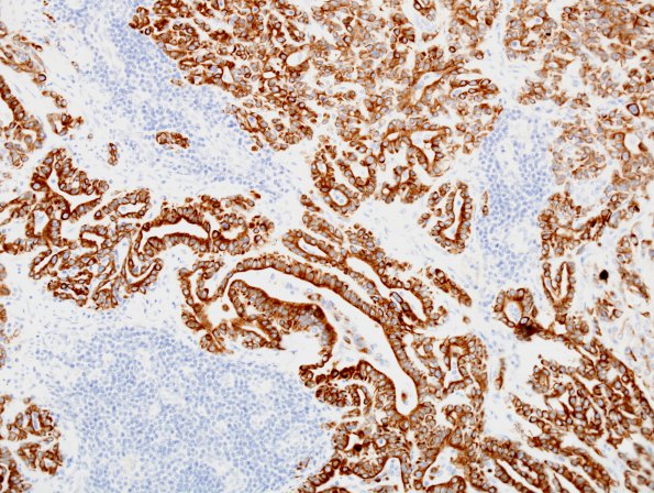 20D2 Meningioma, WHO III & metaplasia (Case 20) CAM 5.2 20x 1.jpg