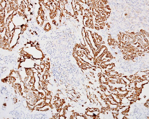 20E Meningioma, WHO III & metaplasia (Case 20) CK1.jpg