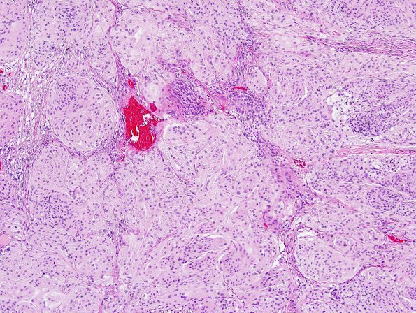 21A1 Meningioma, anaplastic (Case 21) H&E 3.jpg