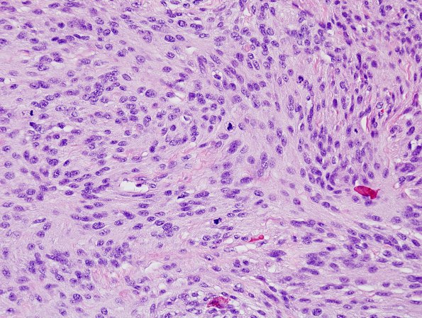 21A2 Meningioma, anaplastic (Case 21) H&E 2.jpg