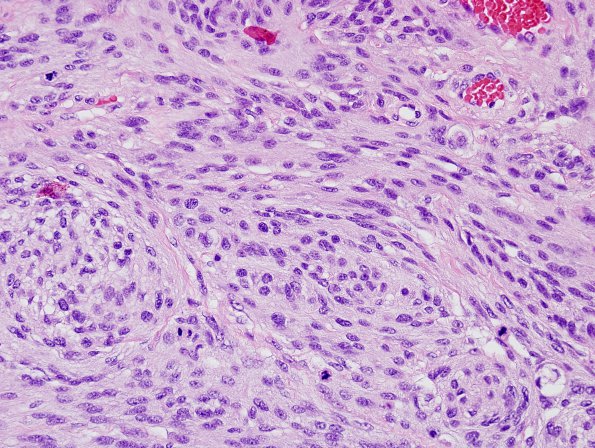 21A3 Meningioma, anaplastic (Case 21) H&E 4.jpg