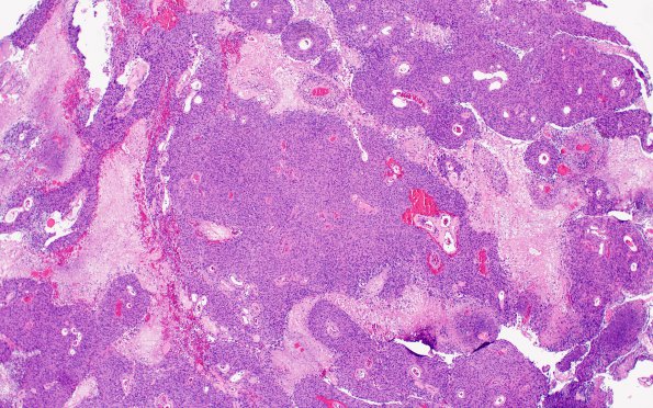 22A1 Meningioma, anaplastic (Case 22) H&E 4X