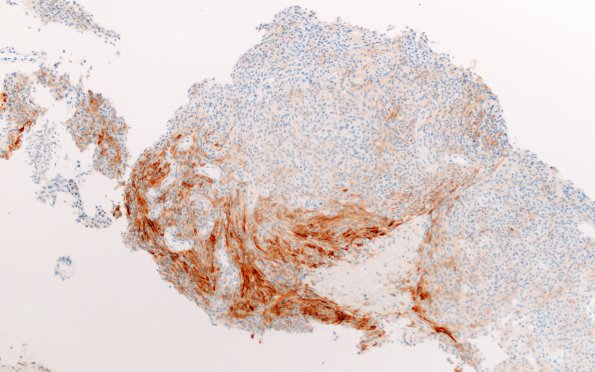 22B Meningioma, anaplastic (Case 22) EMA 10X