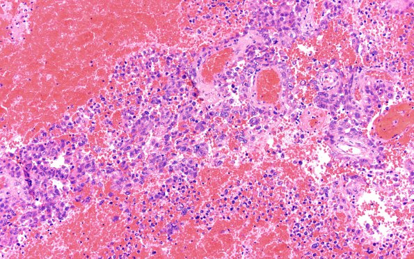 23B1 Meningioma, anaplastic (Case 23) B4 H&E 20X