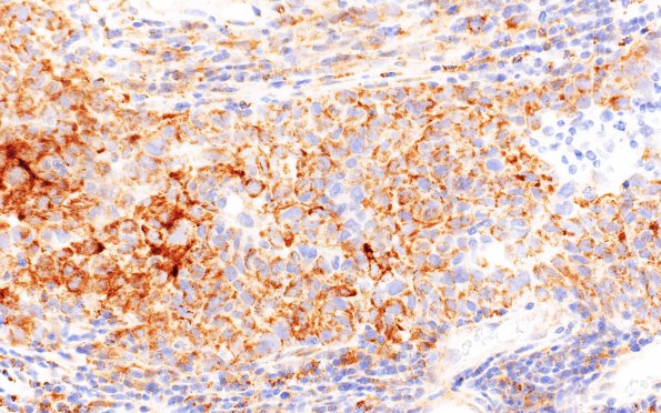 23D Meningioma, anaplastic (Case 23) B4 STAT6 40X 2