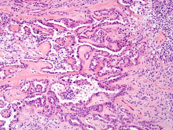 24A Meningioma, WHO III w metaplasia (Case 24)