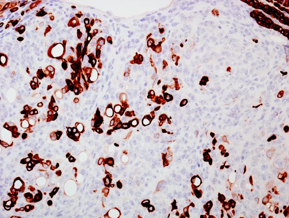 24B1 Meningioma, WHO III w metaplasia (Case 24) CK7 1.jpg