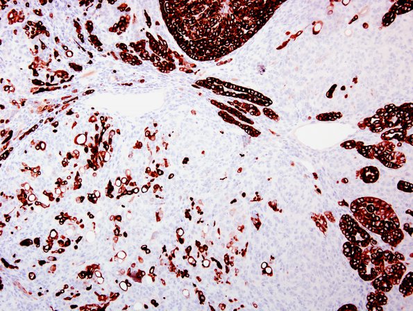 24B2 Meningioma, WHO III w metaplasia (Case 24) CK7 2.jpg