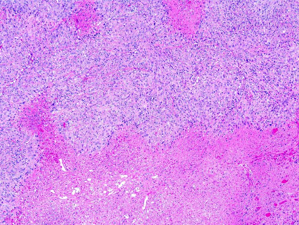 25A1 Meningioma, anaplastic (Case 25) 1.jpg