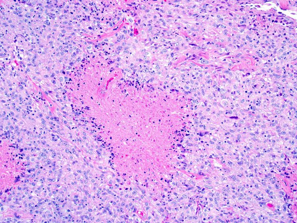 25A2 Meningioma, anaplastic (Case 25) 3.jpg