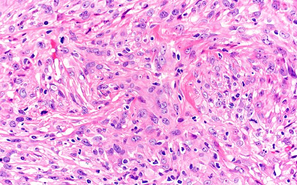 25A3 Meningioma, anaplastic (Case 25) H&E 40X