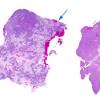 26A1 Meningioma, anaplastic & Chondrosarc (Case 26) H&E WM copy