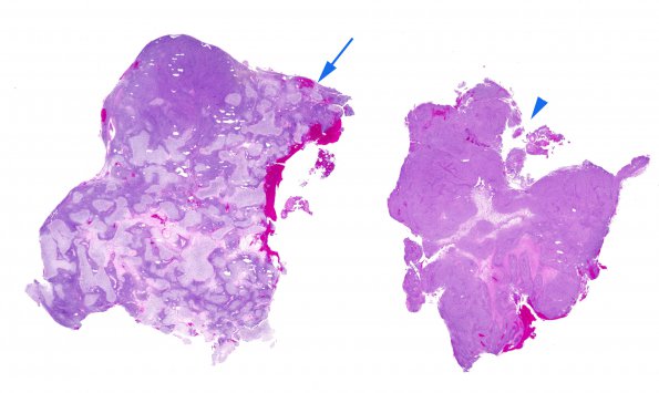 26A1 Meningioma, anaplastic & Chondrosarc (Case 26) H&E WM copy