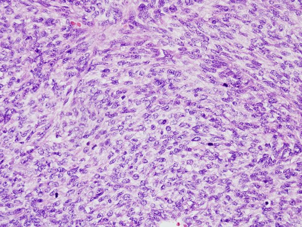 26A2 Meningioma, anaplastic & Chondrosarc (Case 26) H&E 9.jpg