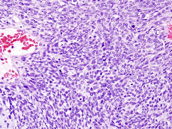 26A3 Meningioma, anaplastic & Chondrosarc (Case 26) H&E 7.jpg