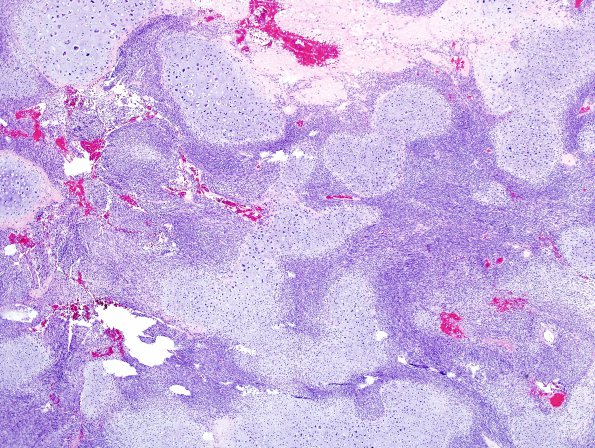 26A4 Meningioma, anaplastic & Chondrosarc (Case 26) H&E 5.jpg