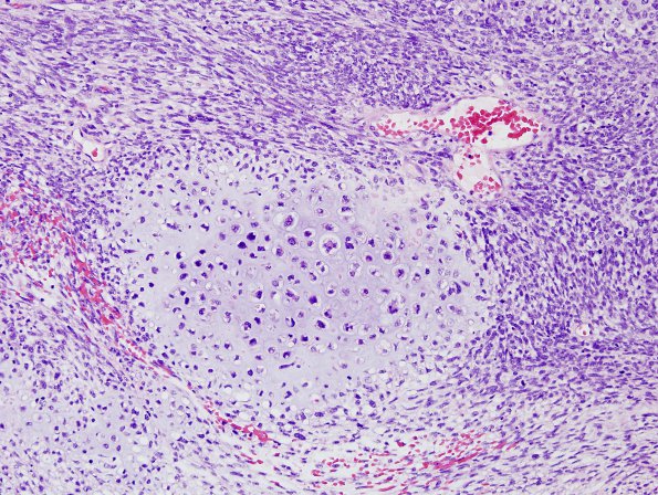 26A5 Meningioma, anaplastic & Chondrosarc (Case 26) H&E 6.jpg