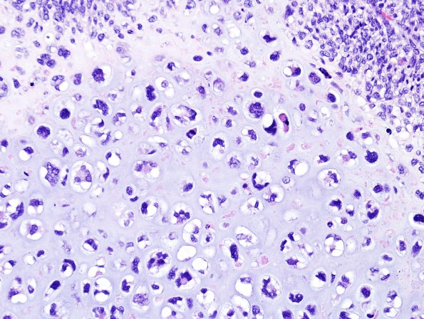 26A6 Meningioma, anaplastic & Chondrosarc (Case 26) H&E 4.jpg