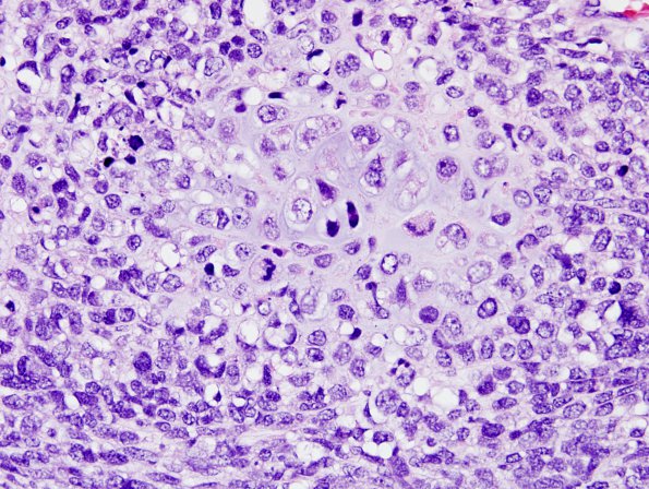 26A7 Meningioma, anaplastic & Chondrosarc (Case 26) H&E 8.jpg