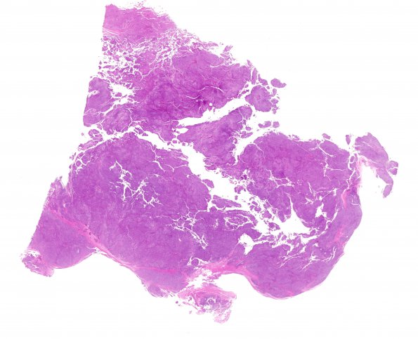 27A1 Meningioma, anaplastic, gland meta (Case 27) H&E WM